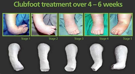 scratch test for ctev|Ponseti Technique for the Management of Congenital Talipes .